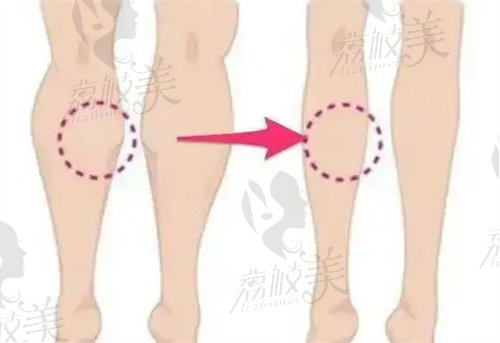 北京艺美王东腿型矫正