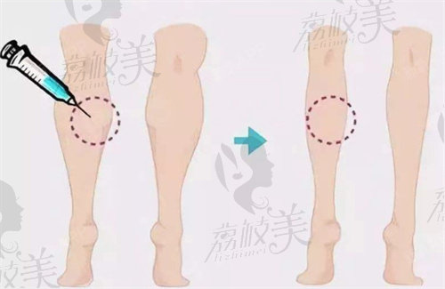 北京艺美王东腿型矫正