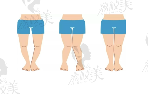 北京艺美王东腿型矫正