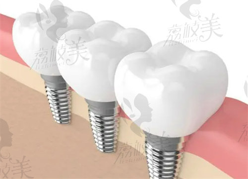 义乌爱康医院口腔科种植牙怎么样
