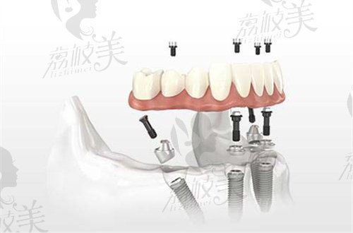 义乌爱康医院口腔科种植牙怎么样