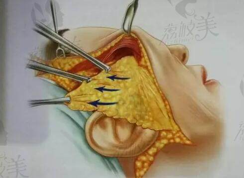 北京陳鳳超做眼部中面部提升多少錢