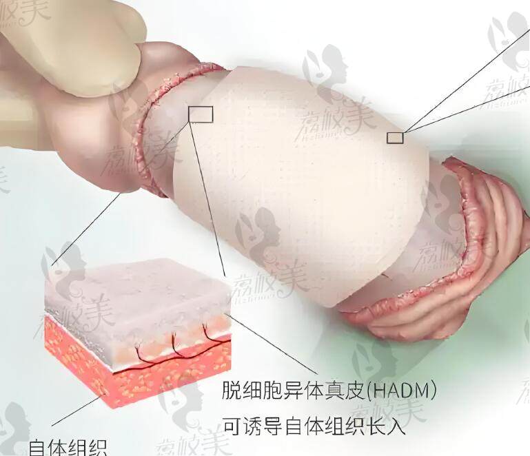 國內(nèi)陰莖延長增粗手術(shù)醫(yī)院哪家好