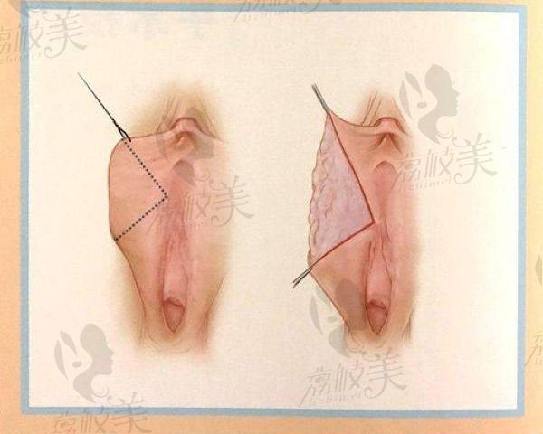 中山打緊縮針的價(jià)格分析