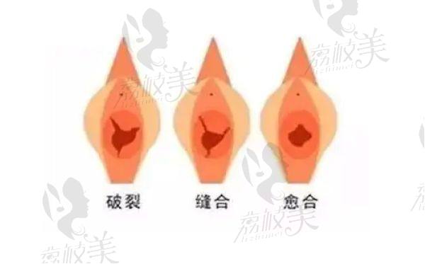 中山打緊縮針預(yù)約