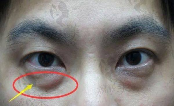 如何预约重 医附一院去眼袋手术