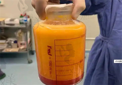 陈克医生吸脂怎么样