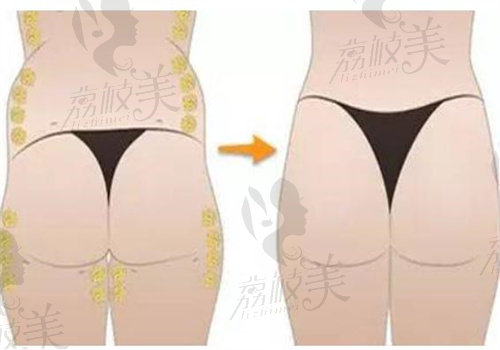 陈克医生吸脂怎么样