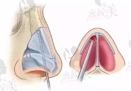 重庆当代王旭明修复鼻子多少钱？