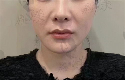 王绍国取生长因子真的能取干净