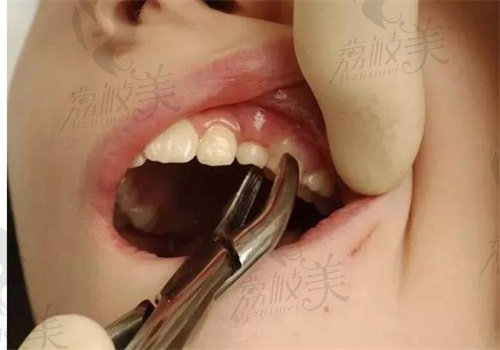 福州美可普口腔医院拔牙怎么样