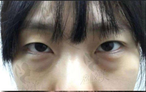 南昌去眼袋的医院有哪些