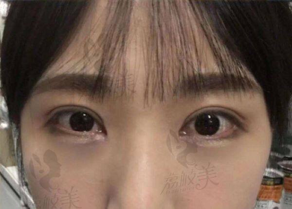 南昌去眼袋那个医院正规技术好