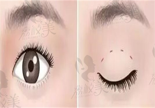 成都江濤做雙眼皮手術(shù)實(shí)例
