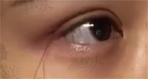 北京克莱美舍张冰洁开外眼角手术
