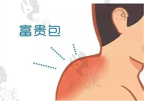 徐淑卿醫(yī)生富貴包手術(shù)實例