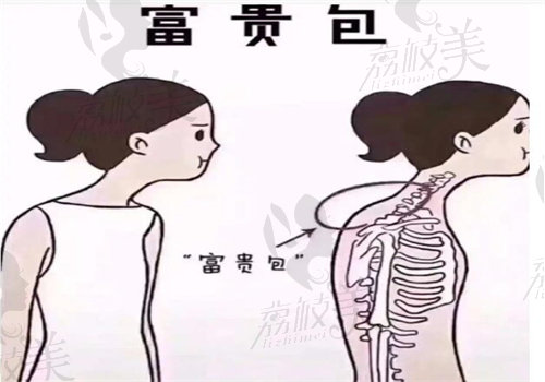 徐淑卿醫(yī)生富貴包手術(shù)價格表