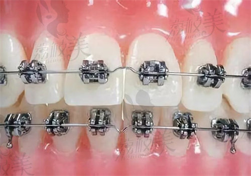 珠海九龙口腔储志强做威兰德全瓷牙具体优势