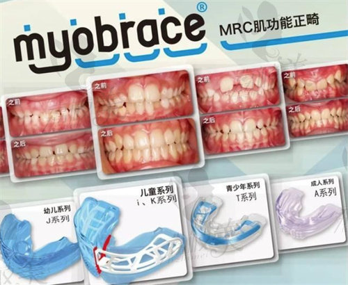海宁牙博士口腔温晔晔做儿童早期干预矫正