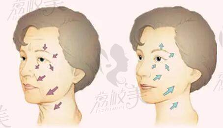 上海倪锋医生拉皮做的怎么样
