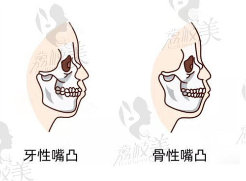 沈陽杏林朱石江骨性凸嘴矯正