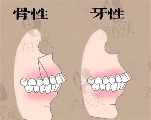 沈陽杏林朱石江骨性凸嘴矯正