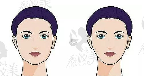 武汉瞿敏面部吸脂
