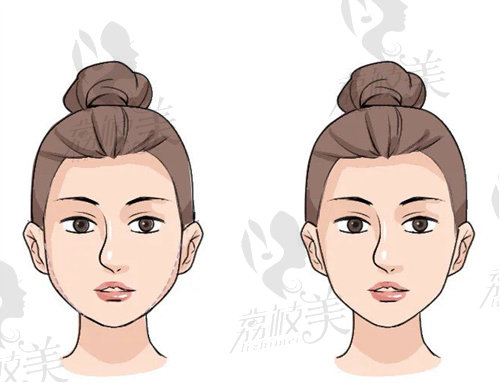 武汉瞿敏面部吸脂