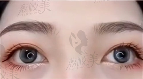 北京张冰洁做真皮卧蚕修复