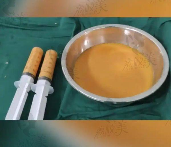 成都艾米丽吸脂医生怎么样