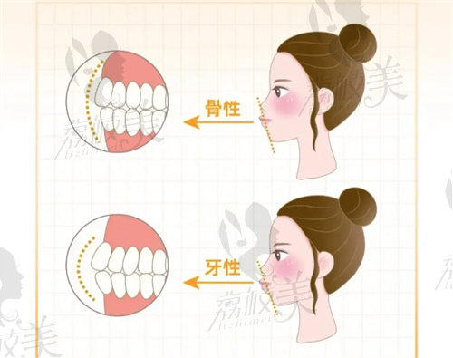 沈阳杏林朱石江做偏颌矫正