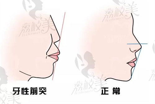 沈阳杏林朱石江做偏颌矫正