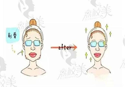 李继华磨骨实例