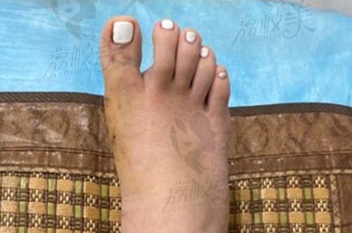 蘇敬達(dá)大腳骨手術(shù)費用是多少？