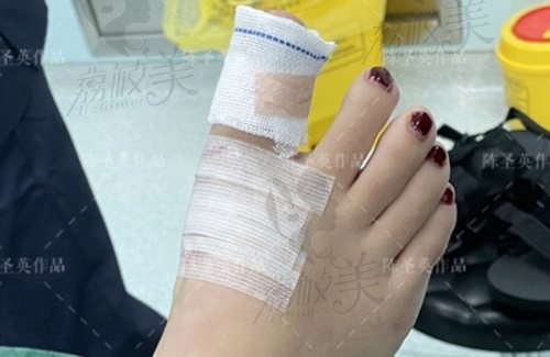蘇敬達(dá)大腳骨手術(shù)費用是多少？