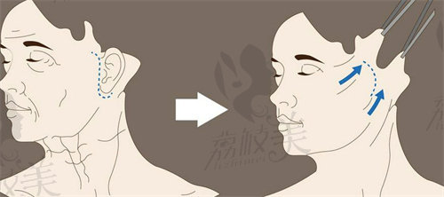 成都美蒂菲梁天琦祺拉皮怎么样
