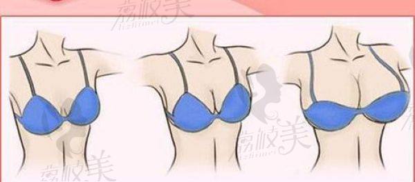 杨连华医生隆胸多少钱