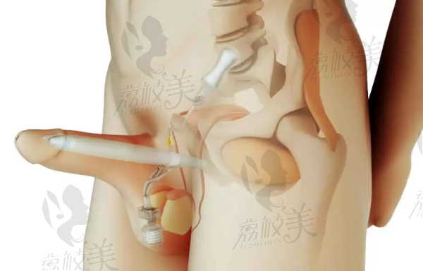 李世荣做生物补片增粗怎么样