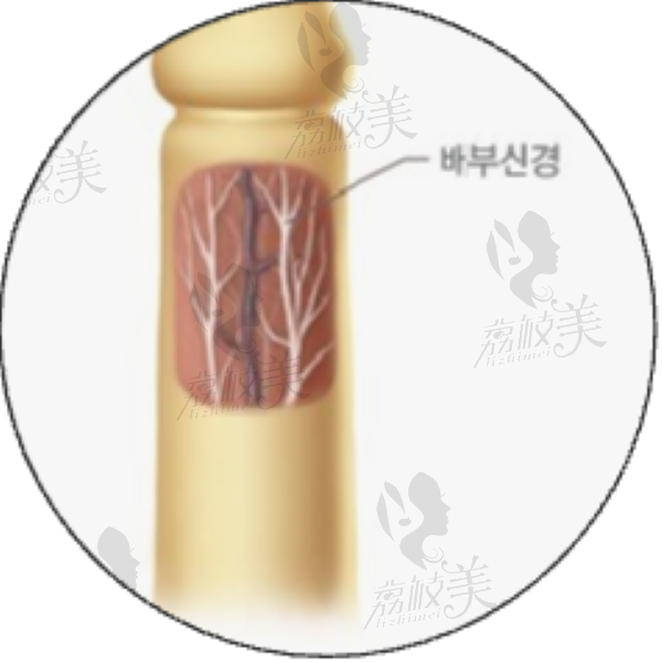 李世荣做生物补片增粗多少钱