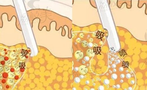 北京英煌脂肪?？漆t(yī)院吸脂技術(shù)