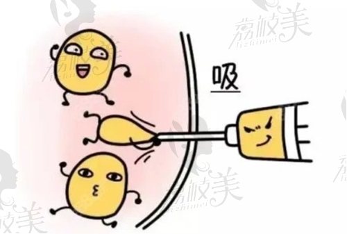 北京英煌脂肪?？漆t(yī)院吸脂技術(shù)