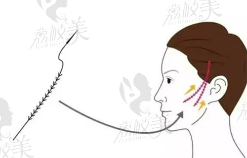 太原時光席曉云做6D童顏線提升