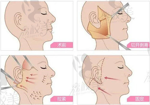 四川現(xiàn)代李獻(xiàn)和做手臂拉皮手術(shù)口碑怎么樣