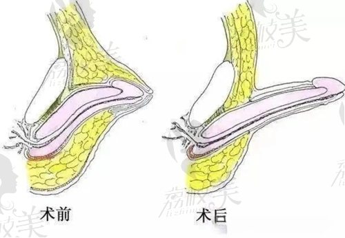 重慶李世榮做陰莖延長增粗術(shù)靠譜嗎？