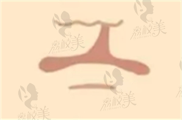 唇裂二次修复哪个医院好？