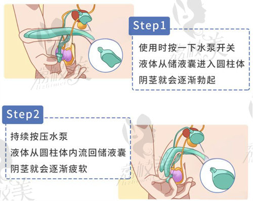 上海九龍醫(yī)院做陰莖假體三件套手術(shù)