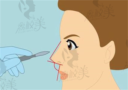 杭州天鑫胡柏做鼻修复手术多少钱