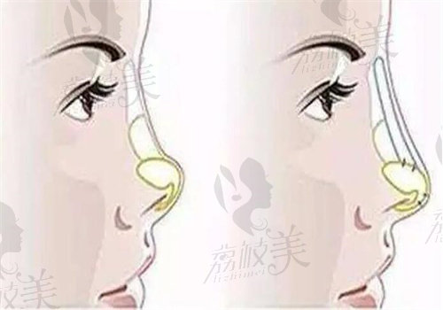 杭州天鑫胡柏做鼻修复手术口碑怎么样
