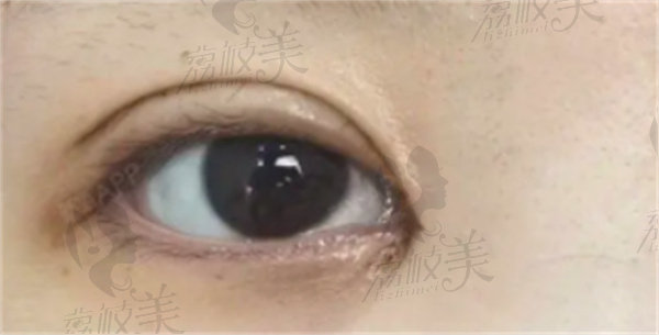 肿胀逐渐消退