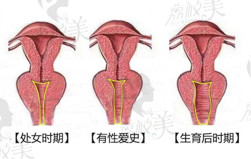 妇科紧缩手术值得做吗